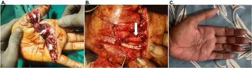 Representative images of Participant #1 (left palm laceration) with exposed flexor digitorum superficialis tendons. (A) Initial presentation. (B) After debridement and placement of the OFM grafts as a circumferential tendon-protective layer to the flexor digitorum superficialis tendons (example indicated with a white arrow). (C) At post-operative week 107.