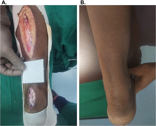 Representative images of Participant #7 (lower extremity, traumatic) with exposed Achilles. (A) After debridement of the defect, prior to OFM placement in the distal incision over the Achilles and flap reconstruction. (B) Week 27, long-term follow-up.