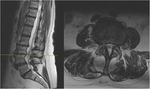 Sagittal and axial section at L3/4 showing no significant spinal stenosis or nerve root impingement.