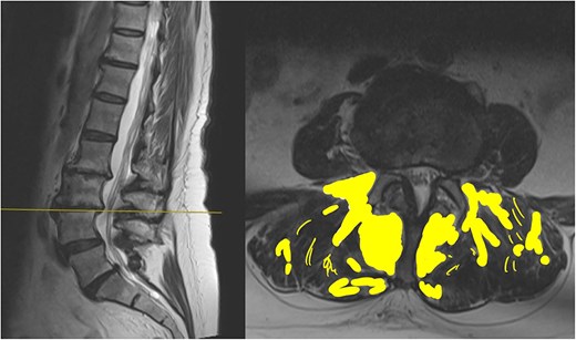 Sagittal and axial section at L3/4. The fat infiltration is highlighted in a yellow shade in this image.