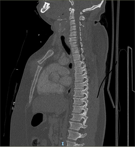 Sagittal view on a CT-thorax of the MSD type 1.