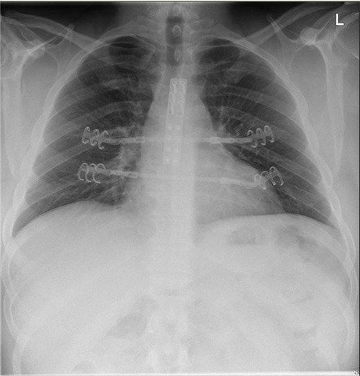 RX thorax of the postoperative reconstruction.