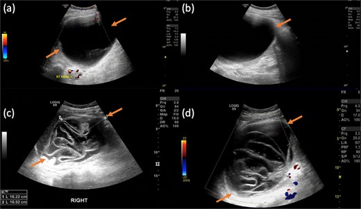 Gray-scale transabdominal ultrasound demonstrates a large well-defined anechoic lesion located in the upper pole of the kidney. The lesion contains internal, non-septated debris and shows no internal vascularity on color doppler imaging (a and b). Compared with previous right renal lesion showing collapsed membranes float within the cyst fluid, resembling water lily.
