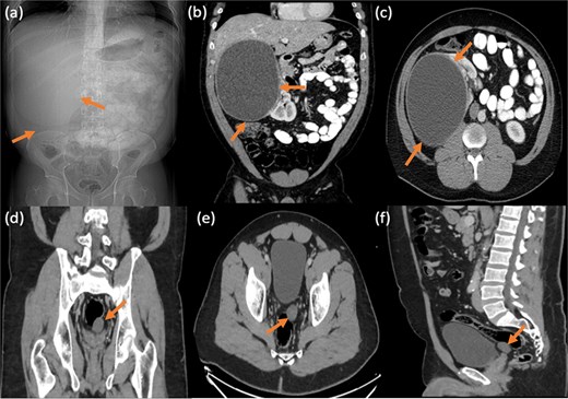 Frontal abdominal radiograph in supine position showing opacity occupying the right upper abdominal region with paucity of bowel loops (a). Followed by contrast enhanced CT abdomen and pelvis with reconstructed images showing a large thick walled non-septated non-calcific right renal cortical cyst (b and c). No right perinephric/pericystic fat stranding or free fluid, preserved tissue planes with surrounding related organs. Incidentally noted small similar looking cystic lesion in the left pelvic region, inseparable from the rectal wall and left seminal vesicle showing no gross fat or calcification (d–f).