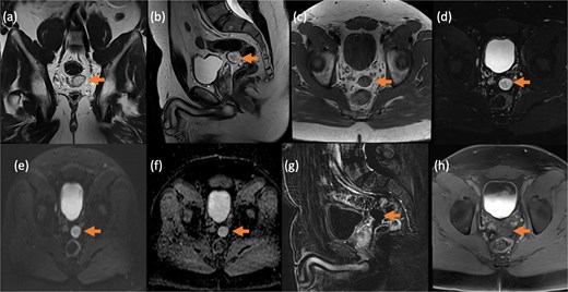 Contrast-enhanced MRI of the pelvis in different sequences and different planes demonstrates a small, well-defined, oval-shaped lesion with high signal intensity on T2-weighted images (bold arrow—a and b) and low signal intensity on T1-weighted images (bold arrow—c). The lesion is located in the pelvis, inseparable from the seminal vesicles and the anterior rectal wall. It shows no signal drop on fat-saturated T2 sequence (bold arrow—d) no signify macroscopic fat, no restricted diffusion (dashed arrow—e and f) with T2 shine through, and no post-contrast enhancement on early subtracted (arrow head—g) and no delayed enhancement (arrow head—h). No solid component.