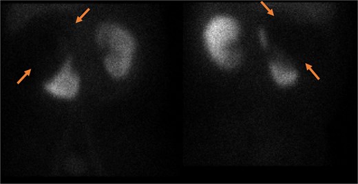 Static image of the abdomen at 2 h after IV injection TC-99 m DMSA, showing normal morphology & corticotubular function of the left kidney. Large photopenic area occupying the upper half of the right kidney while its lower half showed preserved cortical function.