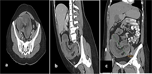 (a) Axial tomography shows the donut sign, thickening of the cecum of up to 10 mm, with reinforcement of the mucosa and muscles, as well as hypodensity of the submucosa. (b) Sagittal tomography showing a loop of ileum and mesentery that are introduced intraluminally into the cecum and ascending colon. (c) Coronal tomography showing a 16 cm long segment of ileum with intussuscepted pneumatosis in the cecum and ascending colon.