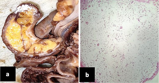 (a) Surgical piece where an 8 cm by 2 cm polypoid lesion is observed in the colon, ulcerated, yellow and fatty in appearance. (b) Microscopic photography. Submucous cecal lipoma made up of numerous mature adipocytes.