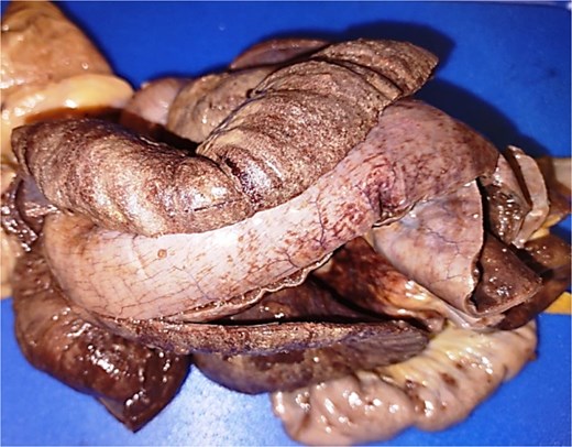 Product of hemicolectomy and ileum segment measuring 18.0 × 2.0 cm, tubular and ischemic in appearance with clear loss of usual architecture due to ileocecal intestinal invagination.