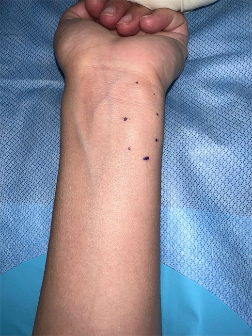 A well-defined, elongated mass measuring ~4 × 3 cm is visible on the ulnar aspect of the distal forearm. The lesion is outlined with small skin markings to delineate its borders.