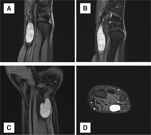 (A) Sagittal MRI scan of the distal forearm demonstrating a well-defined, hyperintense lesion on the ulnar aspect, suggestive of a fluid-rich or soft tissue mass. (B) Sagittal MRI scan depicting an elongated, well-circumscribed hyperintense lesion with no evidence of bone involvement or perilesional edema. (C) Coronal MRI scan showing a lobulated mass, raising suspicion for a nerve sheath tumour or multilobulated ganglion cyst. (D) Axial MRI view confirming an encapsulated lesion within the deep soft tissue of the distal forearm.