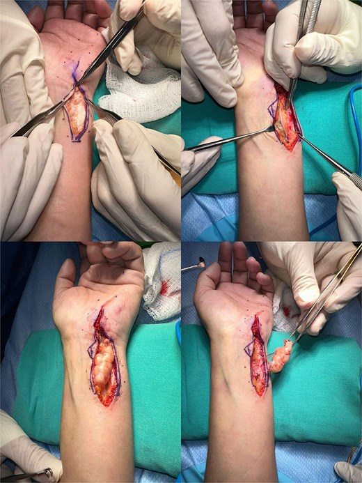 Intraoperative photographs showing surgical exposure and excision of both schwannomas. The primary mass was located along the ulnar aspect of the distal forearm. A second, smaller lesion was identified intraoperatively within the Guyon canal and excised.