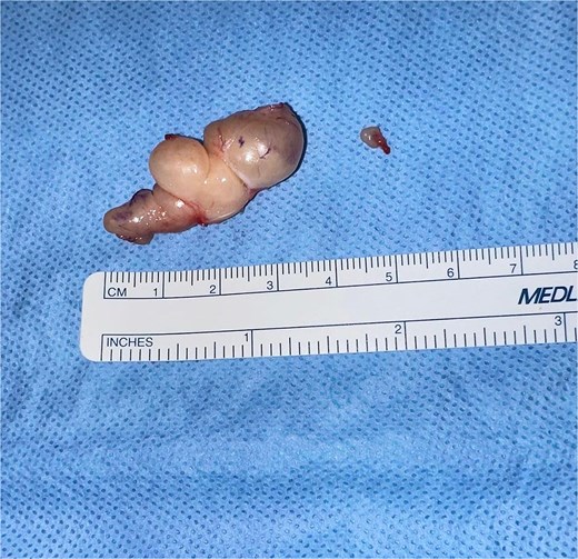Gross photograph of excised schwannomas. The larger, multilobulated mass (left), measuring ~4 × 3 cm, corresponds to the schwannoma visualized on MRI. The smaller lesion (right), ~0.5 × 0.5 cm, was discovered intraoperatively within the Guyon canal. Both tumours were completely excised.