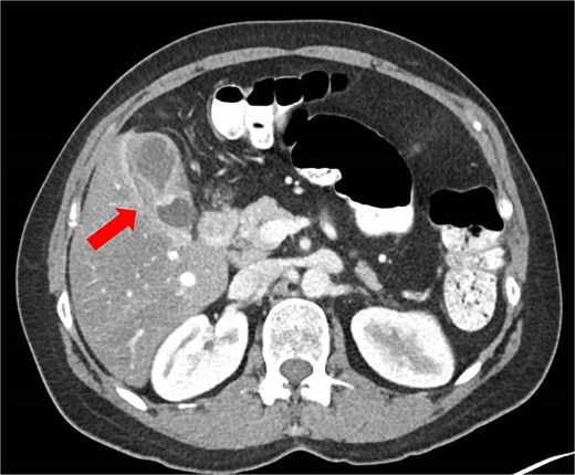 Abdominal CT scan showing an ‘hourglass’ appearance of the gallbladder (arrow).