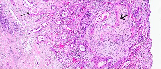 Magnified view (haematoxylin and eosin stain, ×10) of the gallbladder showing mucin glands related to the adenomatous component (narrow arrow) and solid features including stromal infiltration of the squamous components (thick arrow).
