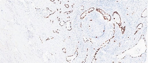Immunohistochemical stain is positive for p40, highlighting squamous differentiation.