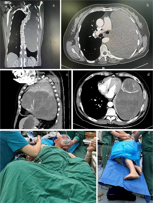 Computed tomography (CT) planes of case 1 in (a) coronal and (b) transverse planes and case 2 in (c) sagittal and (d) transverse planes. The (e) semirecumbent left-tilted posture of case 2 during anesthesia induction and the (f) right lateral decubitus position with the operating bed tilted leftward of case 2 during surgery.