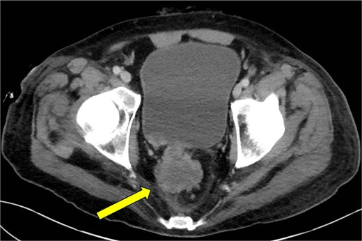 CT abdomen and pelvis—coronal plane. Primary rectal tumor measuring 4.3 × 4.5 cm.