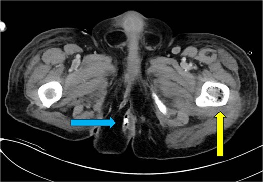 CT abdomen and pelvis—axial plane. Intraosseous gas is seen in the left femur at roughly the level of the lesser trochanter (yellow arrow, right). A previously drained perianal abscess (blue arrow, left).