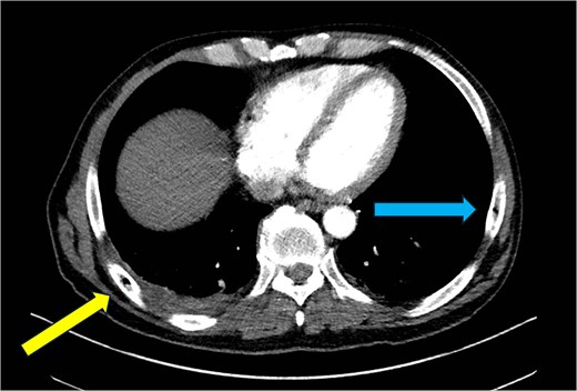 CT chest—axial plane. Intraosseous gas visualized in the right sixth rib (yellow arrow, left) and left seventh rib (blue arrow, right).