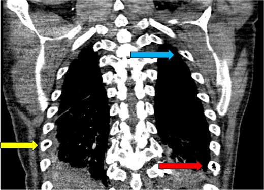 CT chest—coronal plane. Intraosseous gas is seen within the right sixth rib (yellow arrow, bottom left), left second rib (blue arrow, top right), and left eighth rib (red arrow, bottom right).