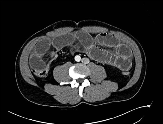 CT showing transition point in right iliac fossa.