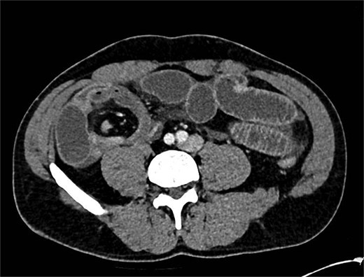 CT showing abnormality in right iliac fossa with dilated bowel loops.