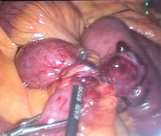 Adhesions from the tip of the giant Meckel’s diverticulum.