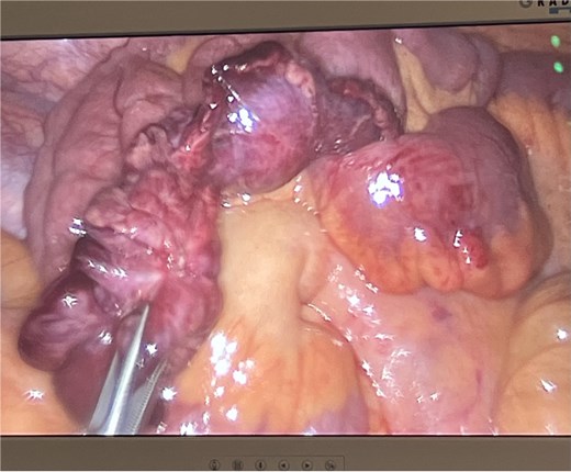 Ischaemic giant Meckel’s diverticulum.