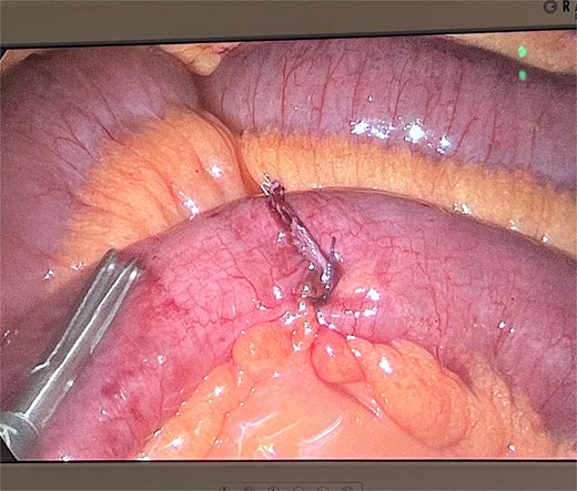 Terminal ileum post-resection of giant Meckel’s diverticulum.