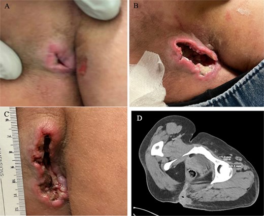 A 38-year-old female presenting with a nonhealing ulcer. (A) Initial presentation (3 cm). (B) Second presentation. (C) Presentation to wound care facility with a 6 × 2.5 × 3–4 cm wound. (D) CT abdomen pelvis. CT findings include an 8.4 × 4 × 3.7 cm left buttock mass with suspicious right inguinal and bilateral internal iliac lymph nodes.