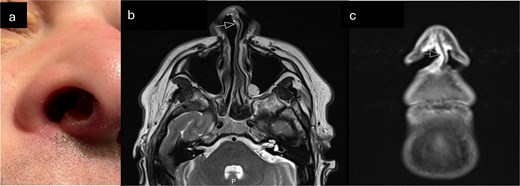 (a) Clinical photograph demonstrating ulcerated lesion of anterior membranous nasal septum (b) T2 axial MRI-arrow indicates soft tissue thickening of columella (c) Coronal STIR MRI sequence—high signal soft tissue thickening extending from columella to right nasal sill (indicated by arrow).