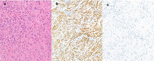 (a) Haematoxylin and eosin (H&E) sections show a spindle cell proliferation with no discernible atypia, short fascicles of cells with spindled nuclei with some vague zonation, SMA immunohistochemistry is positive (b), whilst desmin (c) is negative.