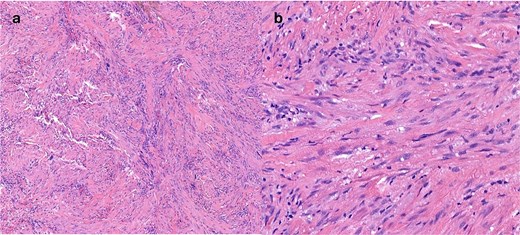 (a) H&E stain of surgically resected specimen (b) high powered image of surgically resected specimen showing nuclear detail.