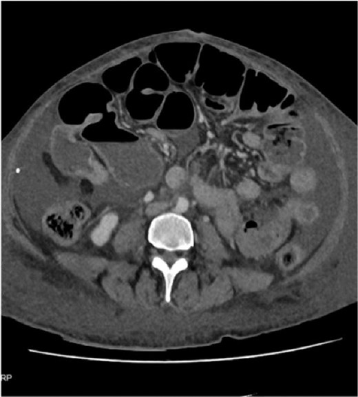 CT abdomen pelvis.