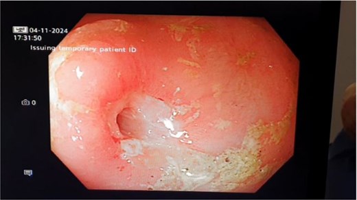 Small bowel stricture at endoscopy.