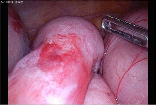 Inflammation evident at laparoscopy.