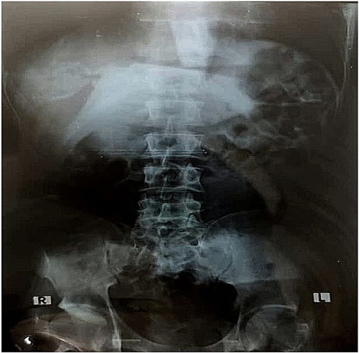 Abdominal X-ray showing no visible foreign body.