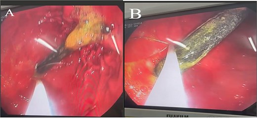 EGD demonstrating a manual toothbrush lodged in the stomach, with its head extending into the first part of the duodenum (D1). (A) The toothbrush head embedded within the gastric folds, partially coated with bile and food residue. (B) The elongated handle visible along the gastric body.