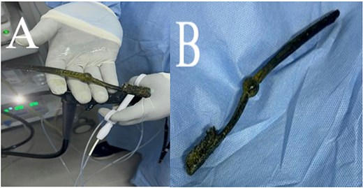 Endoscopic retrieval of the toothbrush using a polypectomy snare. (A) The snare securely grasping the toothbrush after removal. (B) The extracted toothbrush, removed in one piece without mucosal injury.