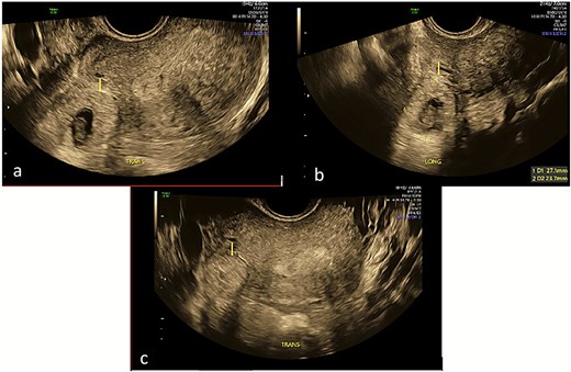 Transverse and longitudinal views of the uterus on trans-vaginal ultrasound demonstrating a right interstitial ectopic pregnancy with gestational sac and foetal pole. Image A demonstrates a decidual reaction around the gestational sac in a transverse plane through the uterus. Image B measures the gestational sac in the longitudinal plane. Image C demonstrates that the pregnancy does not communicate with the endometrial cavity in a transverse plane through the uterine fundus.
