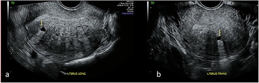 Transvaginal ultrasound of the uterus demonstrating adenomyotic spaces in the myometrium and sub-endometrial border in longitudinal (a) and transverse planes (b), with a notable absence of decidual reaction around the cystic spaces.