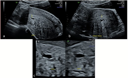 Transabdominal ultrasound of the uterus demonstrating cystic sub-endometrial spaces that were mistaken for a gestational sac in earlier ultrasound scans. The sub-endometrial space is demonstrated in longitudinal (a) and transverse planes (b) and under magnification (c) with a notable absence of decidual reaction around the cystic space.