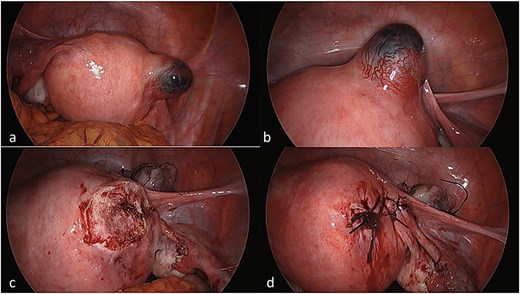 Laparoscopic views of the interstitial ectopic pregnancy. Part A and B demonstrate the pregnancy arising off the interstitial segment of the right fallopian tube at different magnifications, after entry into the peritoneal cavity. Part C is a progress image of the uterus after a unilateral salpingectomy and wedge resection. Part D is a progress image of the uterus after it was closed with a barbed v-lock suture.