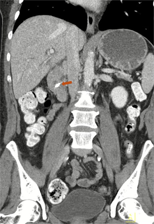 Contrast-enhanced CT of the abdomen demonstrating a migrated clip in the common bile duct (arrow).