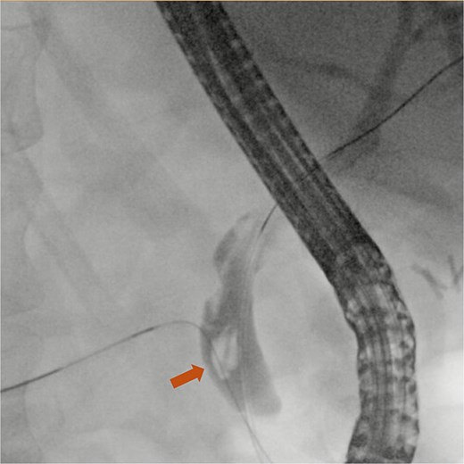 ERCP fluoroscopy image showing a common bile duct stone (arrow).