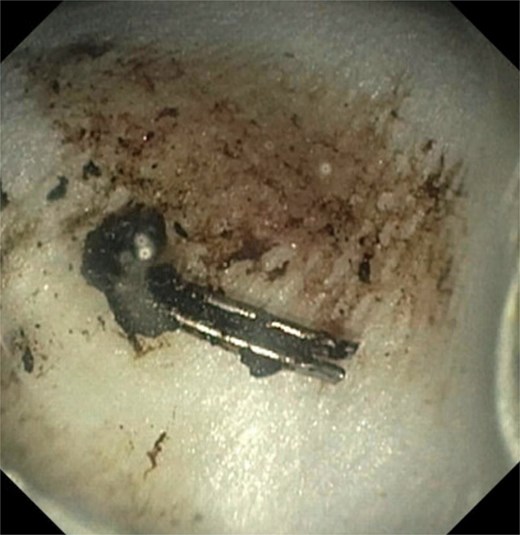 Stone with the clip after stone retrieval.