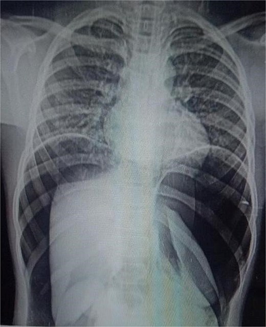 Chest X-rays with pneumoperitoneum.
