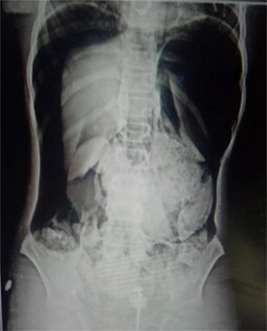 Abdominal X-rays with massive pneumoperitoneum.