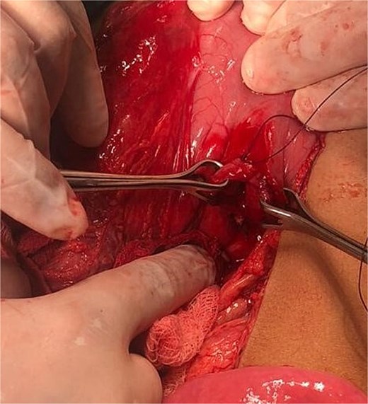 Gastric perforation at lesser curvature.